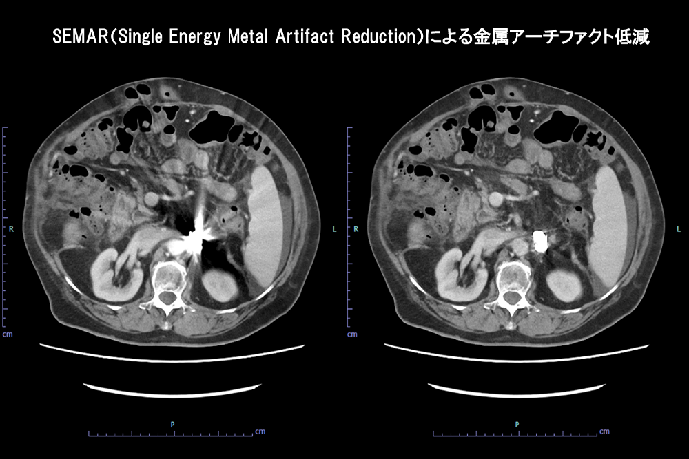 SEMARによる金属アーチファクト低減