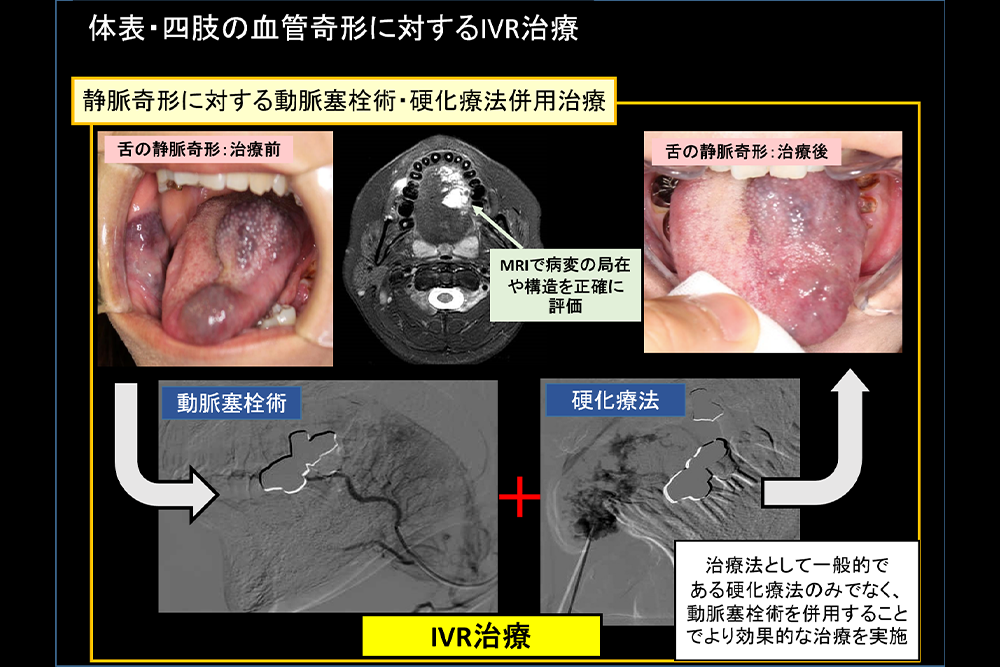 体表・四肢の血管奇形に対するIVR治療