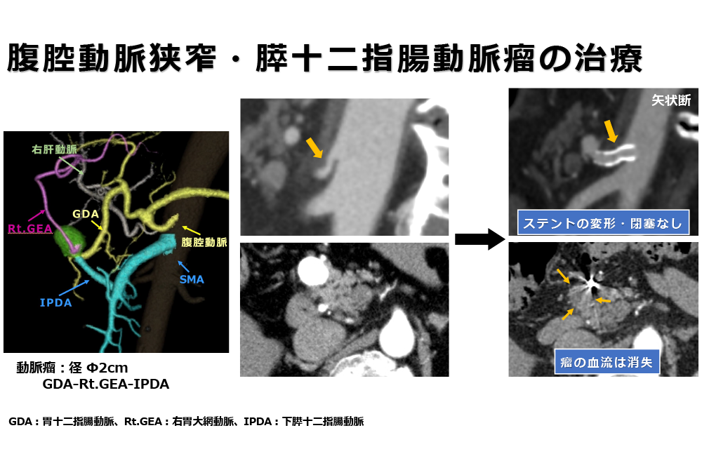 腹腔動脈狭窄・膵十二指腸動脈瘤の治療