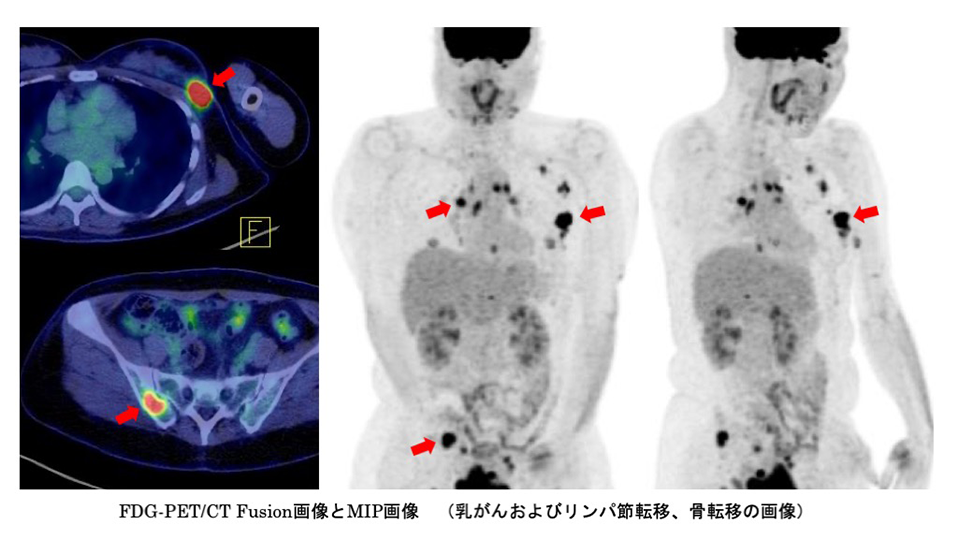 FDG-PET/CT Fusion画像とMIP画像
