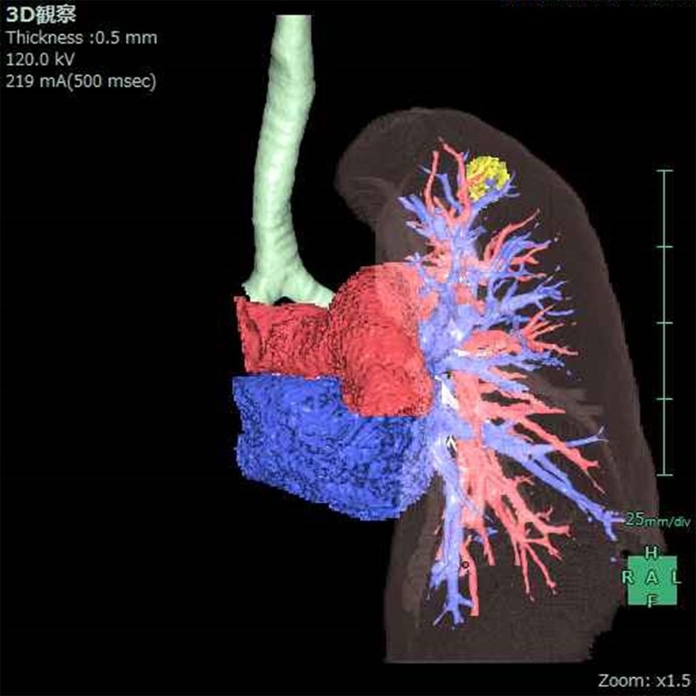 肺動静脈3D再構成