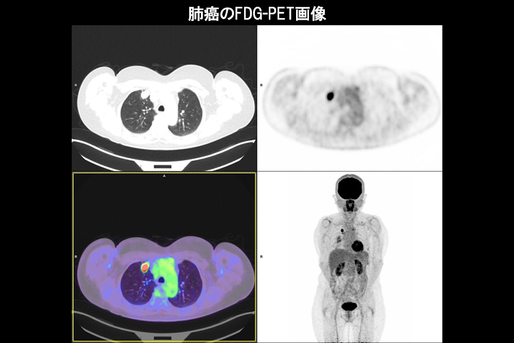 肺癌のFDG-PET画像