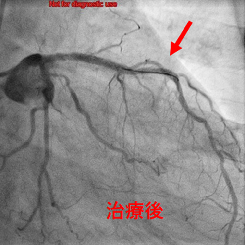 心臓の血管の治療後