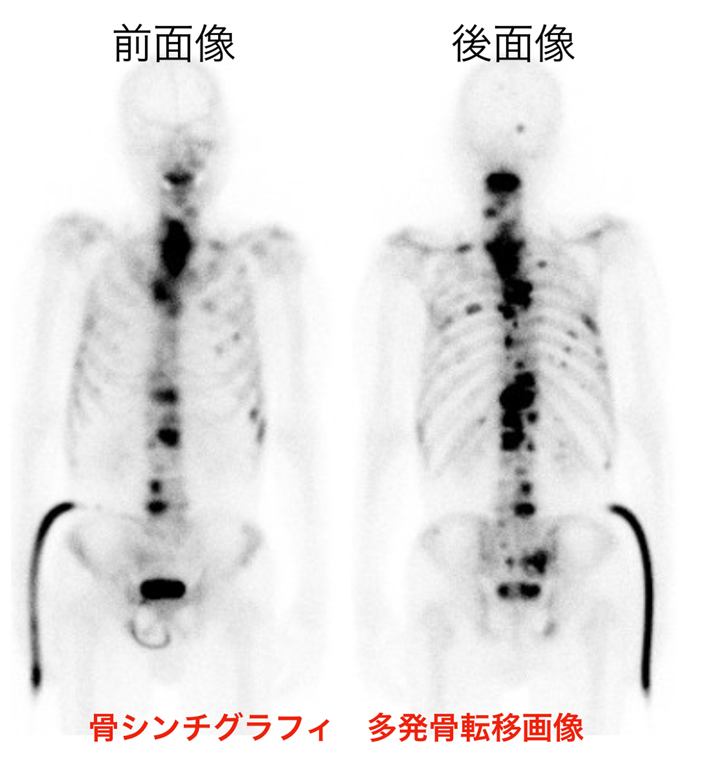 骨シンチグラフィ　多発骨転移画像